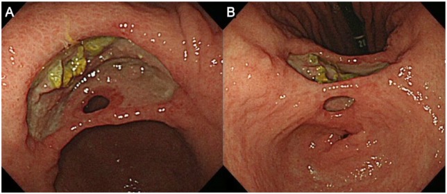 A Case of Gastric Ulcer With Mucosal Bridge.