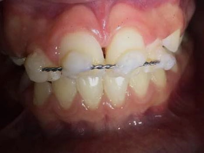 Dental splints: types and time of immobilization post tooth avulsion.