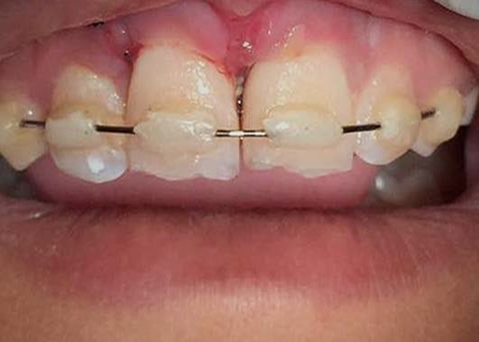 Dental splints: types and time of immobilization post tooth avulsion.