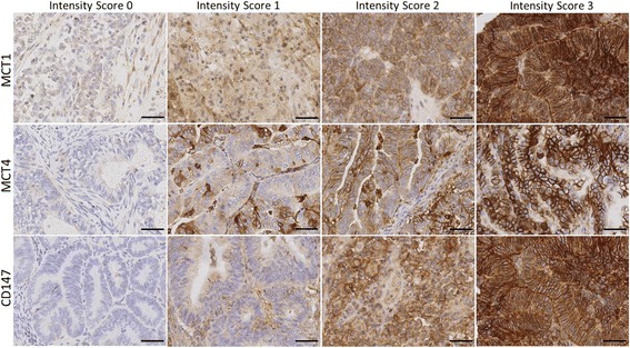 Monocarboxylate Transporter 1 (MCT1) is an independent prognostic biomarker in endometrial cancer.