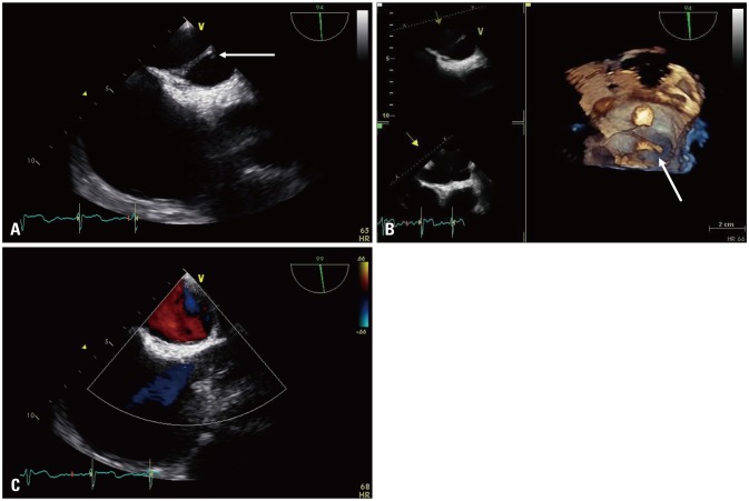 Congenital Left Atrial Bands with Atrial Fibrillation.