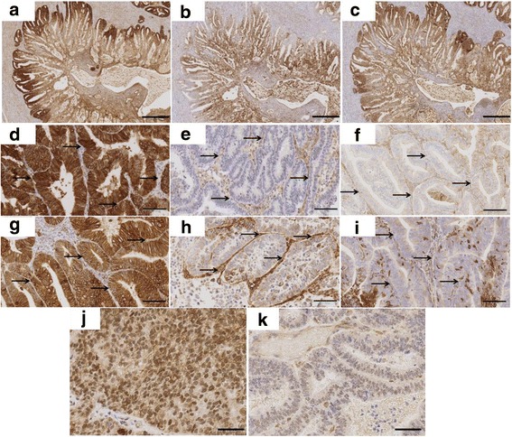 Monocarboxylate Transporter 1 (MCT1) is an independent prognostic biomarker in endometrial cancer.