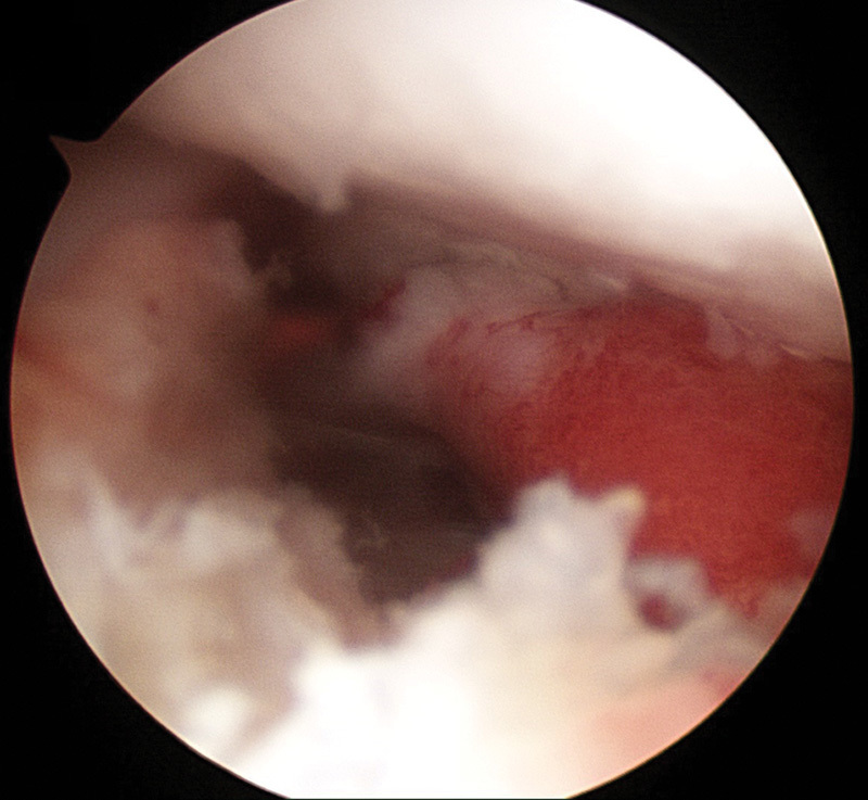 Isolated Subscapularis Tendon Tear in a Skeletally Immature Soccer Player.