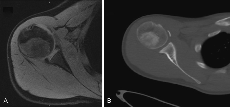 Isolated Subscapularis Tendon Tear in a Skeletally Immature Soccer Player.