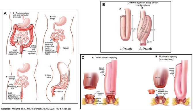 Adaptive Returns of Deficient Systemic Plasma Immunoglobulin G Levels as Rehabilitation Biomarker After Emergency Colectomy for Fulminant Ulcerative Colitis.