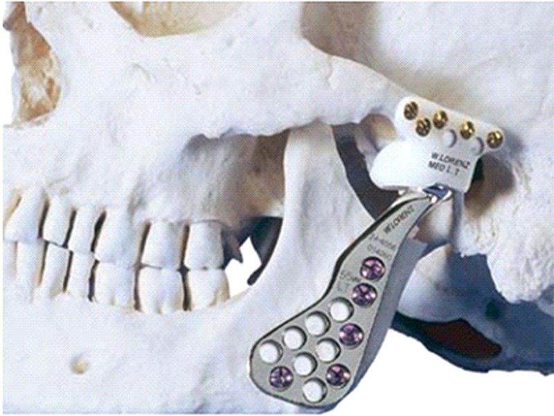 Alloplastic reconstruction of the temporomandibular joint.