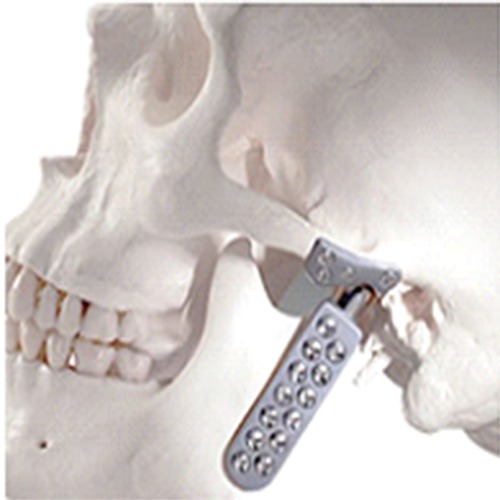 Alloplastic reconstruction of the temporomandibular joint.