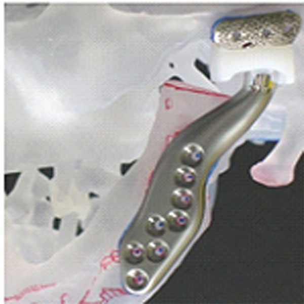 Alloplastic reconstruction of the temporomandibular joint.