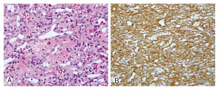 Glomangiopericytoma of the Spinal Cord.