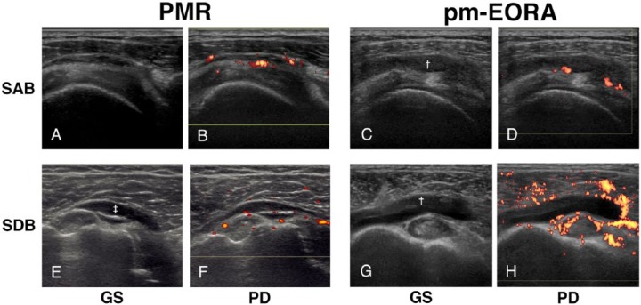 Proliferative Synovitis of the Shoulder Bursae is a Key Feature for Discriminating Elderly Onset Rheumatoid Arthritis Mimicking Polymyalgia Rheumatica From Polymyalgia Rheumatica.