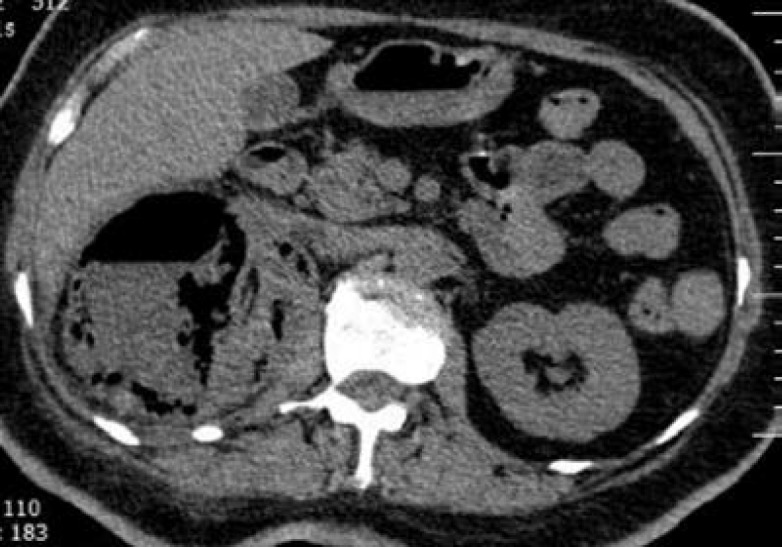 Fever and Flank Pain in a Diabetic Woman; a Case of Emphysematous Pyelonephritis.