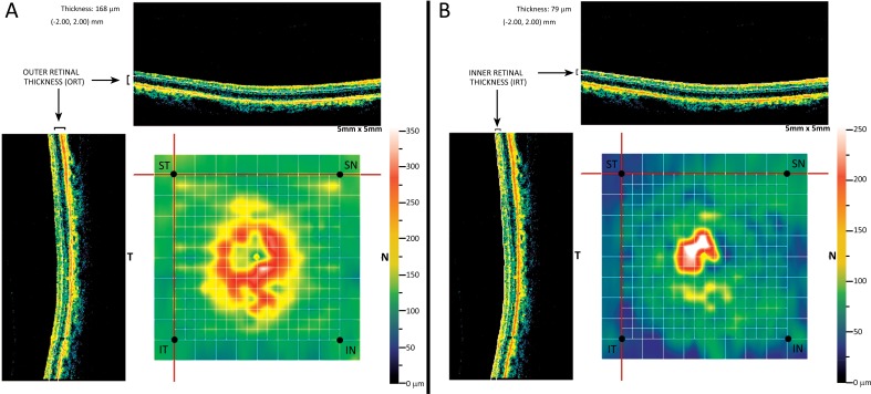 The Effect of Ranibizumab on Normal Neurosensory Retina in the Eyes of Patients with Exudative Age Related Macular Degeneration.