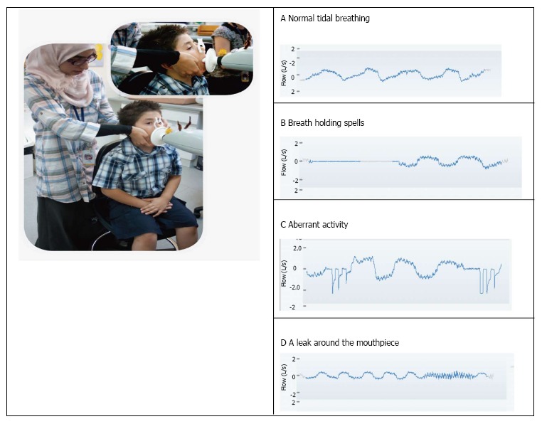 Is forced oscillation technique the next respiratory function test of choice in childhood asthma.