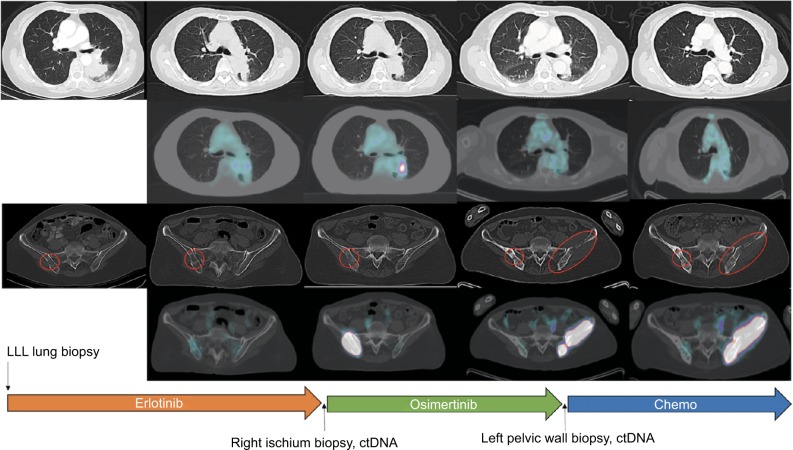 <i>Cis</i>-oriented solvent-front EGFR G796S mutation in tissue and ctDNA in a patient progressing on osimertinib: a case report and review of the literature.