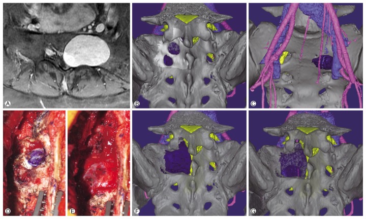 Virtual Preoperative Simulation for Excision of Spinal Tumors: Surgeon Processing of Medical Computer-Assisted Design Software.