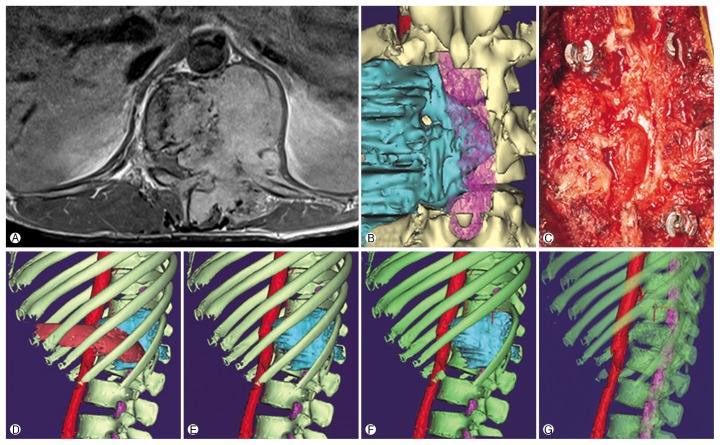 Virtual Preoperative Simulation for Excision of Spinal Tumors: Surgeon Processing of Medical Computer-Assisted Design Software.