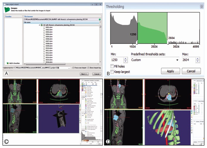 Virtual Preoperative Simulation for Excision of Spinal Tumors: Surgeon Processing of Medical Computer-Assisted Design Software.