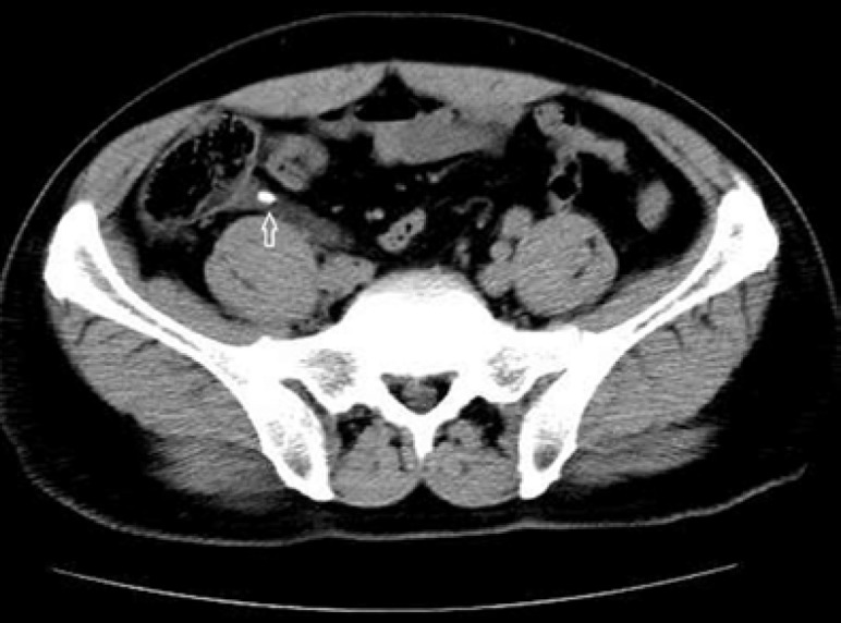 A 58-year-old Man with Abdominal Pain; Acute Appendicitis due to an Appendicolith.