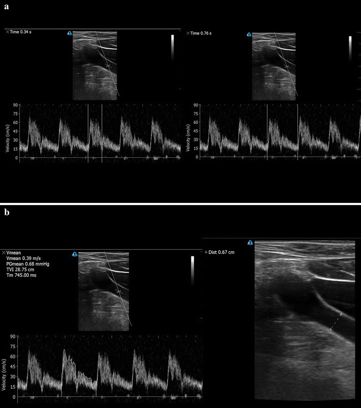 Correlation of carotid blood flow and corrected carotid flow time with invasive cardiac output measurements.