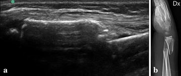 Minimal training sufficient to diagnose pediatric wrist fractures with ultrasound.