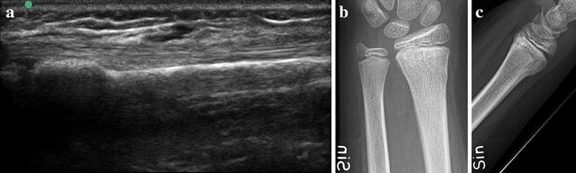 Minimal training sufficient to diagnose pediatric wrist fractures with ultrasound.