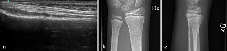 Minimal training sufficient to diagnose pediatric wrist fractures with ultrasound.