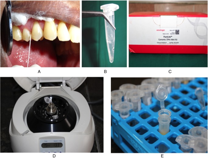 Diode laser therapy in the management of chronic periodontitis - A clinico-microbiological study.