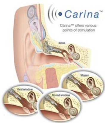 Implantable hearing devices.