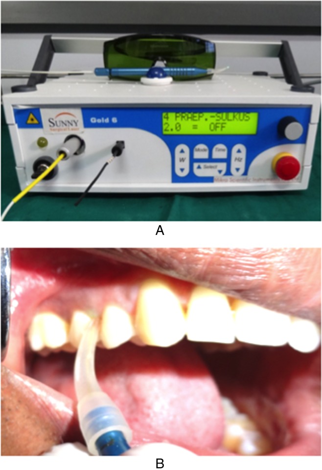 Diode laser therapy in the management of chronic periodontitis - A clinico-microbiological study.