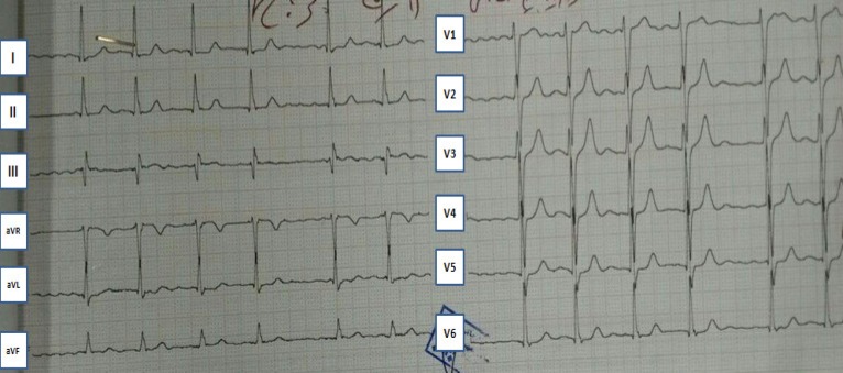 A 58-Year-Old Woman with Weakness and Shortness of Breath.