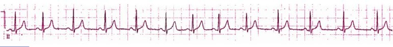 A 58-Year-Old Woman with Weakness and Shortness of Breath.