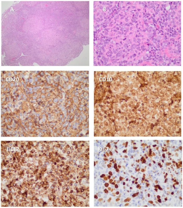 Transformation of Follicular Lymphoma to a High-Grade B-Cell Lymphoma With MYC and BCL2 Translocations and Overlapping Features of Burkitt Lymphoma and Acute Lymphoblastic Leukemia: A Case Report and Literature Review.