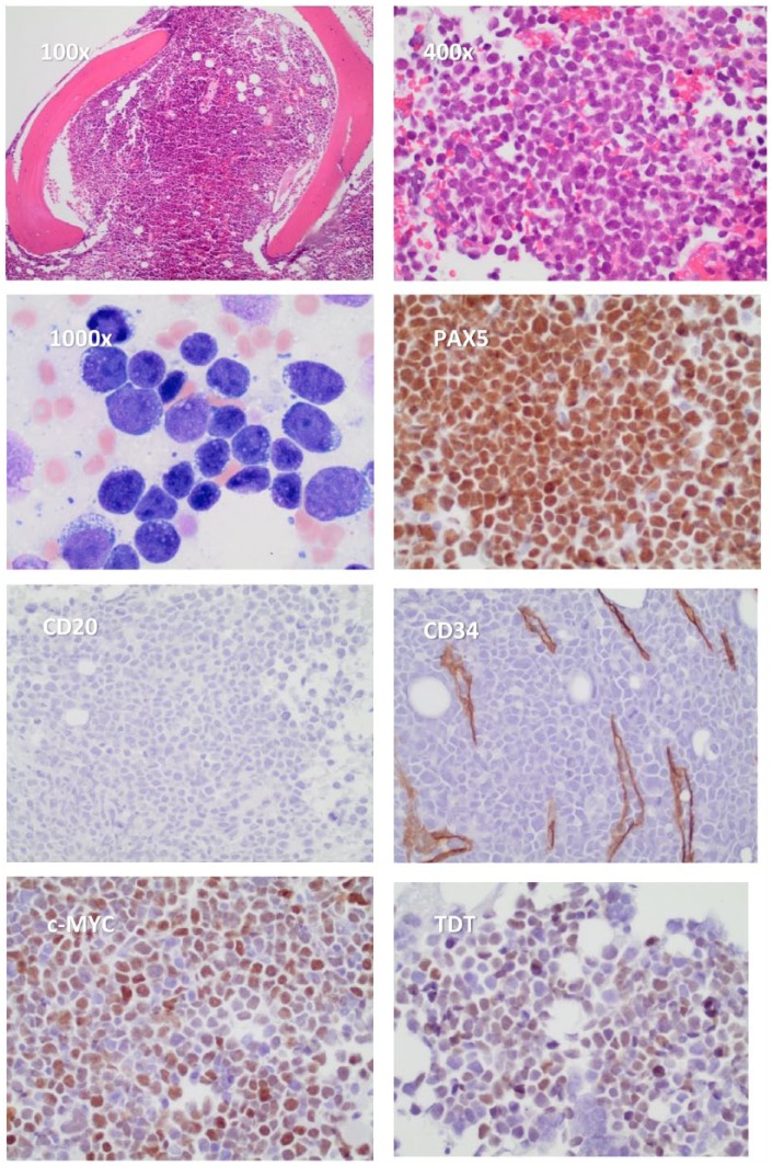 Transformation of Follicular Lymphoma to a High-Grade B-Cell Lymphoma With MYC and BCL2 Translocations and Overlapping Features of Burkitt Lymphoma and Acute Lymphoblastic Leukemia: A Case Report and Literature Review.