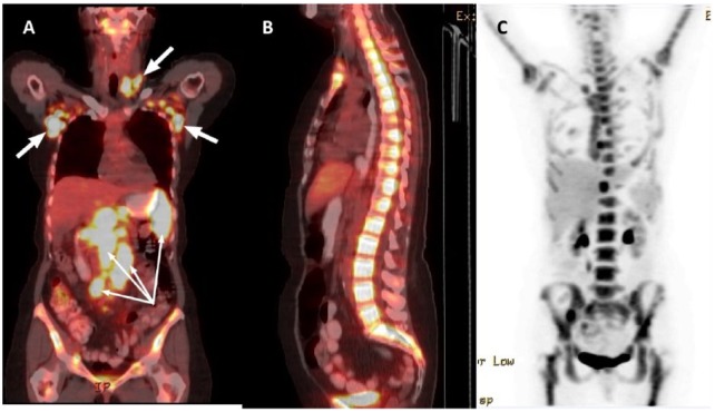 Transformation of Follicular Lymphoma to a High-Grade B-Cell Lymphoma With MYC and BCL2 Translocations and Overlapping Features of Burkitt Lymphoma and Acute Lymphoblastic Leukemia: A Case Report and Literature Review.