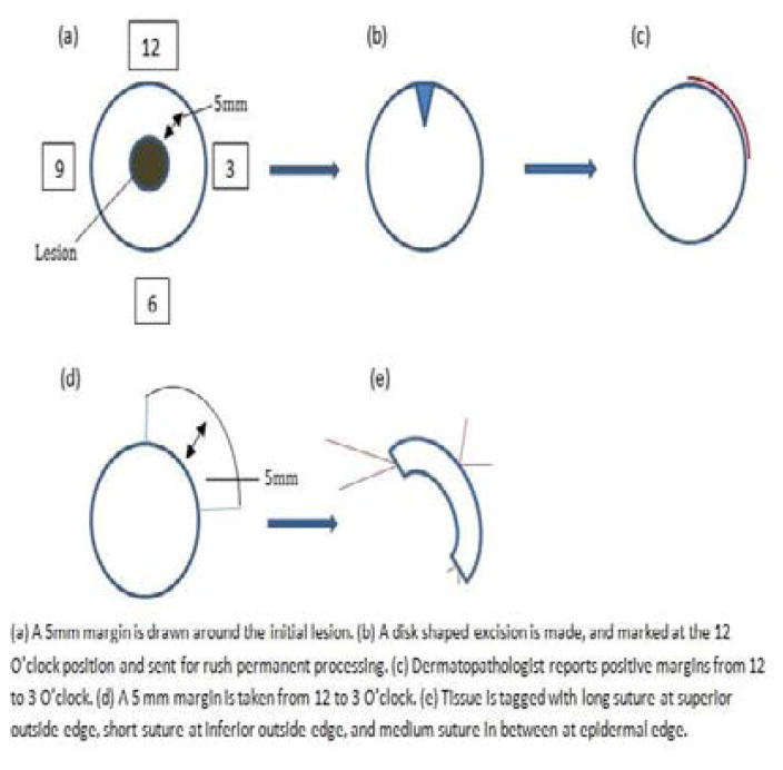 Recurrence Rate of Melanoma in Situ when Treated with Serial Disk Staged Excision: A Case Series.