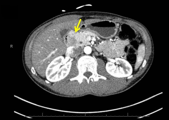 A Rare Tumor in the Common Bile Duct: A Case Report.