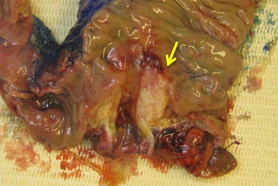 A Rare Tumor in the Common Bile Duct: A Case Report.