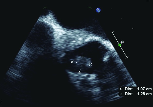 Successful treatment of <i>Listeria monocytogenes</i> prosthetic valve endocarditis using rifampicin and benzylpenicillin in combination with valve replacement.