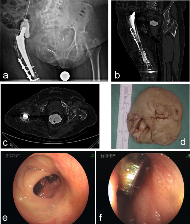 Colon penetration by a femoral prosthesis: a case report.