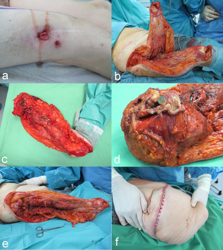 Colon penetration by a femoral prosthesis: a case report.