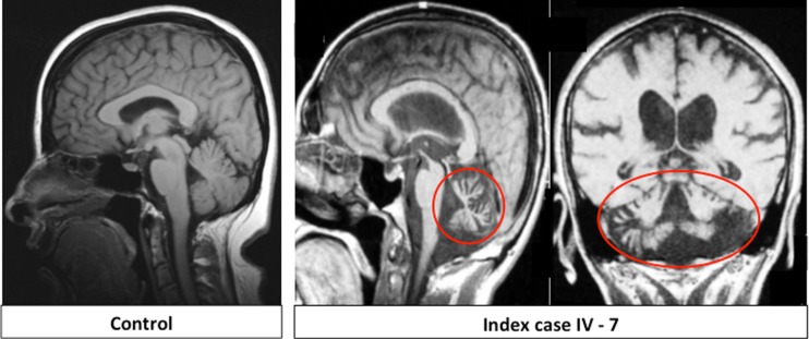 Pure Cerebellar Ataxia with Homozygous Mutations in the PNPLA6 Gene.
