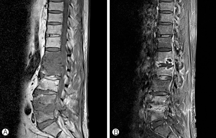 Delayed Spondylodiscitis Presenting as a Skip Lesion.