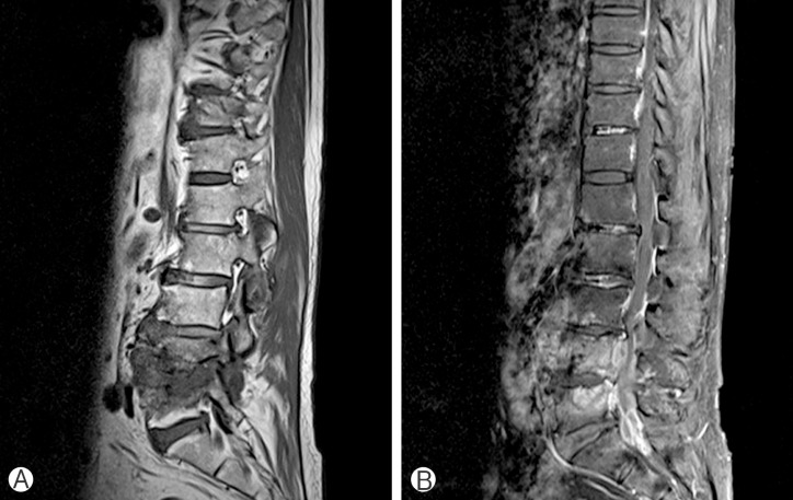 Delayed Spondylodiscitis Presenting as a Skip Lesion.