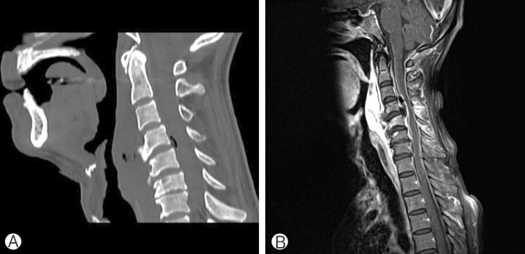 Gas-Containing Cervical Epidural Abscess Accompanying Bacterial Meningitis in an Adult.