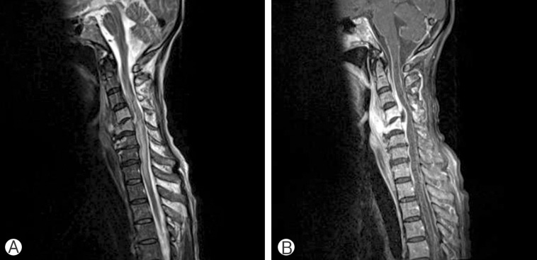 Gas-Containing Cervical Epidural Abscess Accompanying Bacterial Meningitis in an Adult.