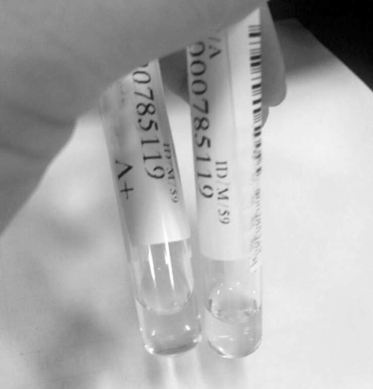 Gas-Containing Cervical Epidural Abscess Accompanying Bacterial Meningitis in an Adult.