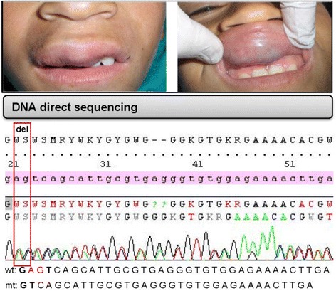 Facial cutaneo-mucosal venous malformations can develop independently of mutation of TEK gene ﻿but may be associated with excessive expression of Src and p-Src.