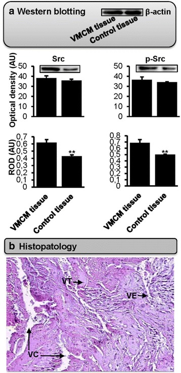 Facial cutaneo-mucosal venous malformations can develop independently of mutation of TEK gene ﻿but may be associated with excessive expression of Src and p-Src.