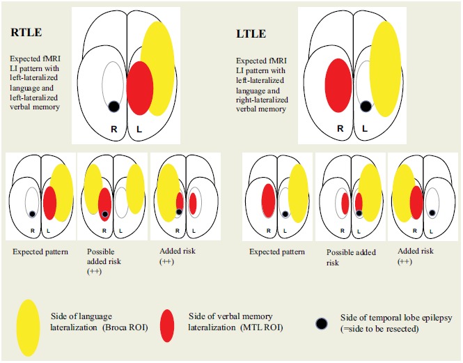 A Functional MRI-Based Model for Individual Memory Assessment in Patients Eligible for Anterior Temporal Lobe Resection.