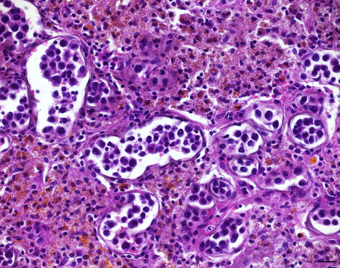 Intravascular T-cell lymphoma in a patas monkey (<i>Erythrocebus patas</i>).